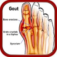 Home Remedies for Gout