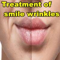 Treatment of smile wrinkles