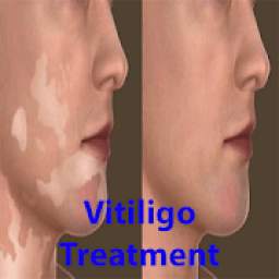 Vitiligo treatment - tips