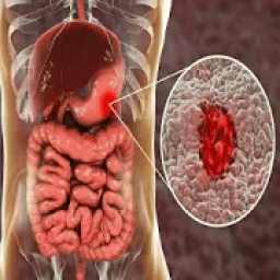 ikon Ulcer Natural &amp; Home Remedies