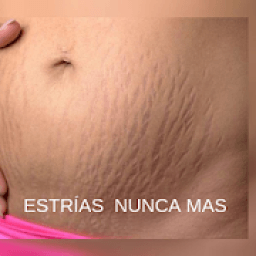 como quitar las estrias: eliminar estrias fácil icon