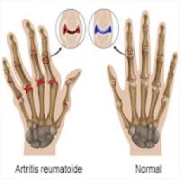 Remedios Naturales Artritis