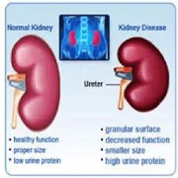 All kidney diseases and Treatment