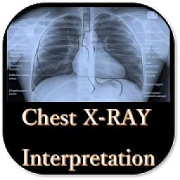 Chest X-Ray Interpretation - A basic guid