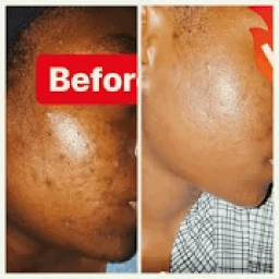 Kurajen fuska da maganinsu icon