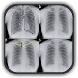 Chest X-Ray Interpretation 2.1